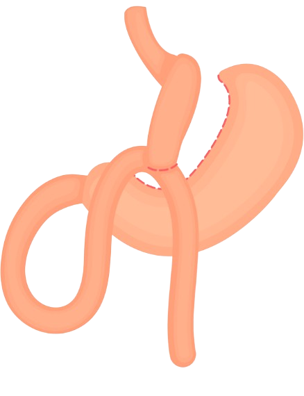 How Mini Gastric Bypass Works