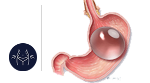 Allurion Balloon Pill